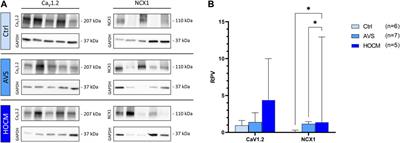 Hypertrophic cardiomyopathy is characterized by alterations of the mitochondrial calcium uniporter complex proteins: insights from patients with aortic valve stenosis versus hypertrophic obstructive cardiomyopathy